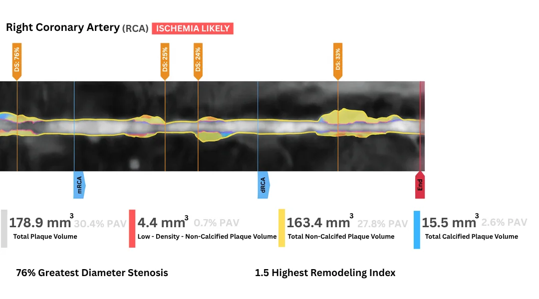 Estudio representativo potenciado con IA de una arteria coronaria derecha (imagen de muestra — no es el estudio de un paciente ni del visitante) — volúmenes de placa cuantificados a una décima de milímetro cúbico. Esto es lo que la mayoría de los cardiólogos nunca revisa. Y esto es lo que causa la mayoría de los infartos.