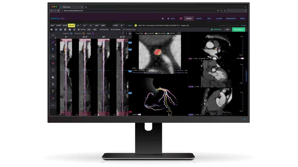 Cleerly Labs report showing AI-quantified coronary plaque on a patient scan